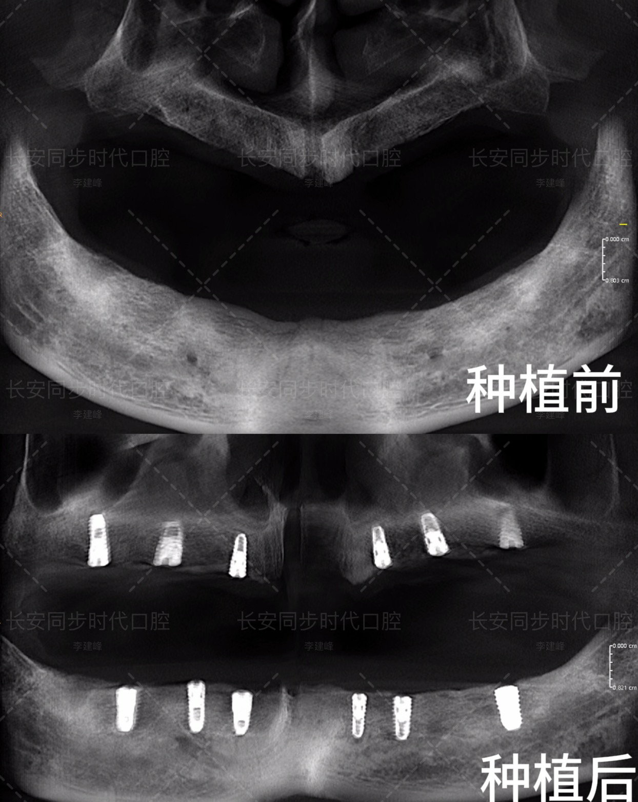 全口缺失种植修复