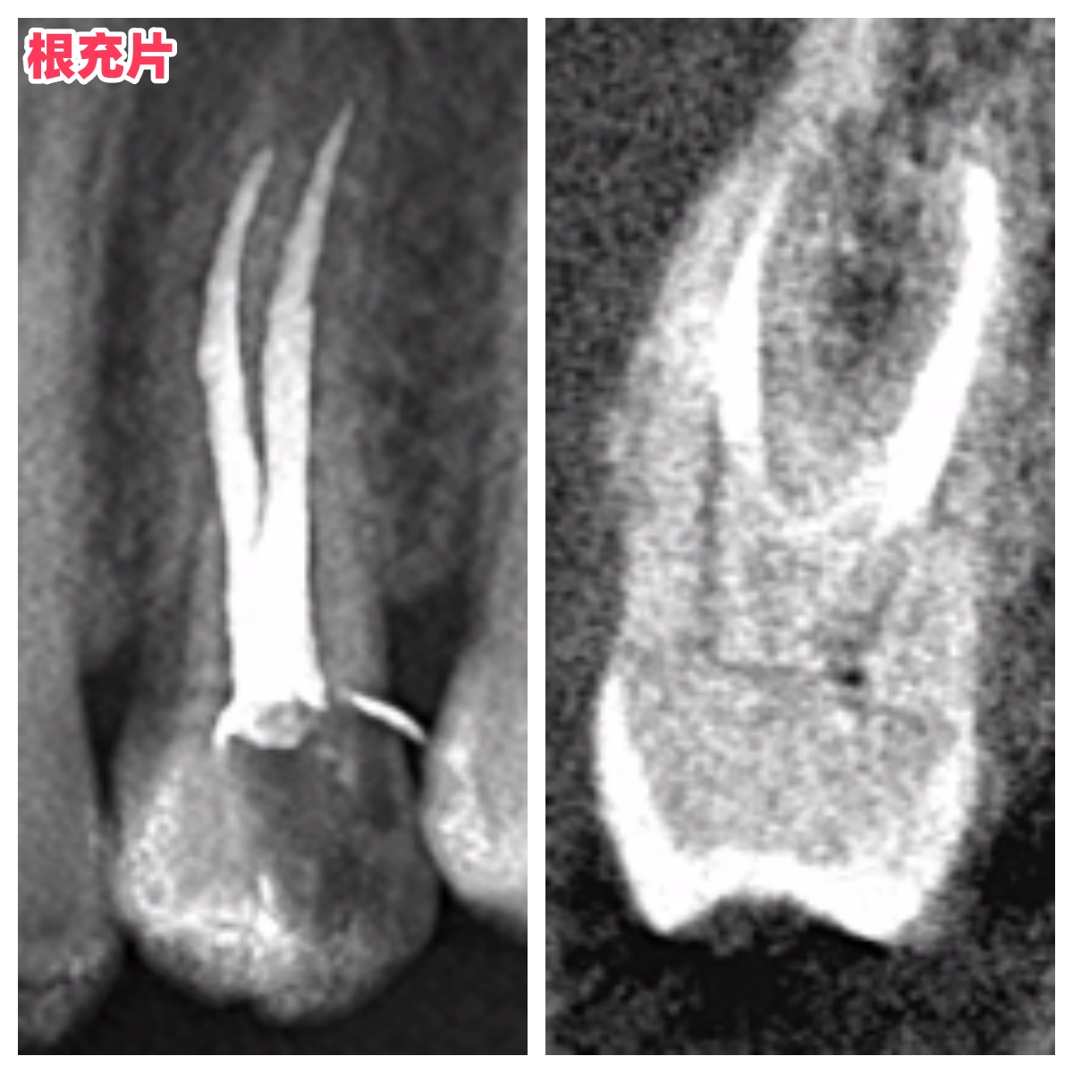 复杂根管再治疗