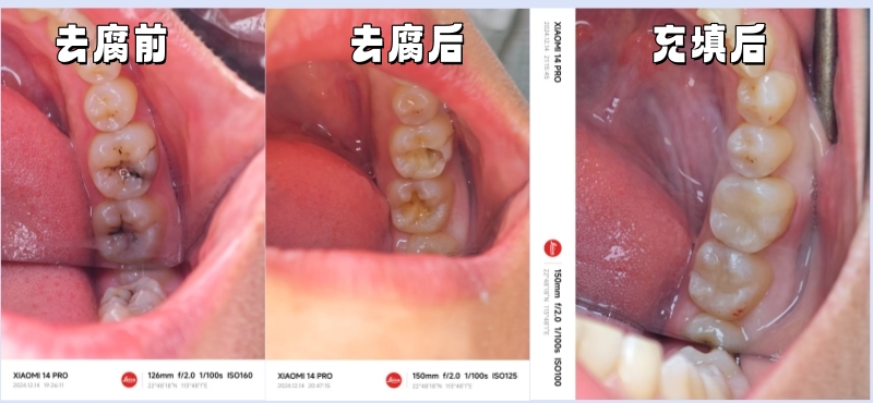 龋坏牙体保存修复