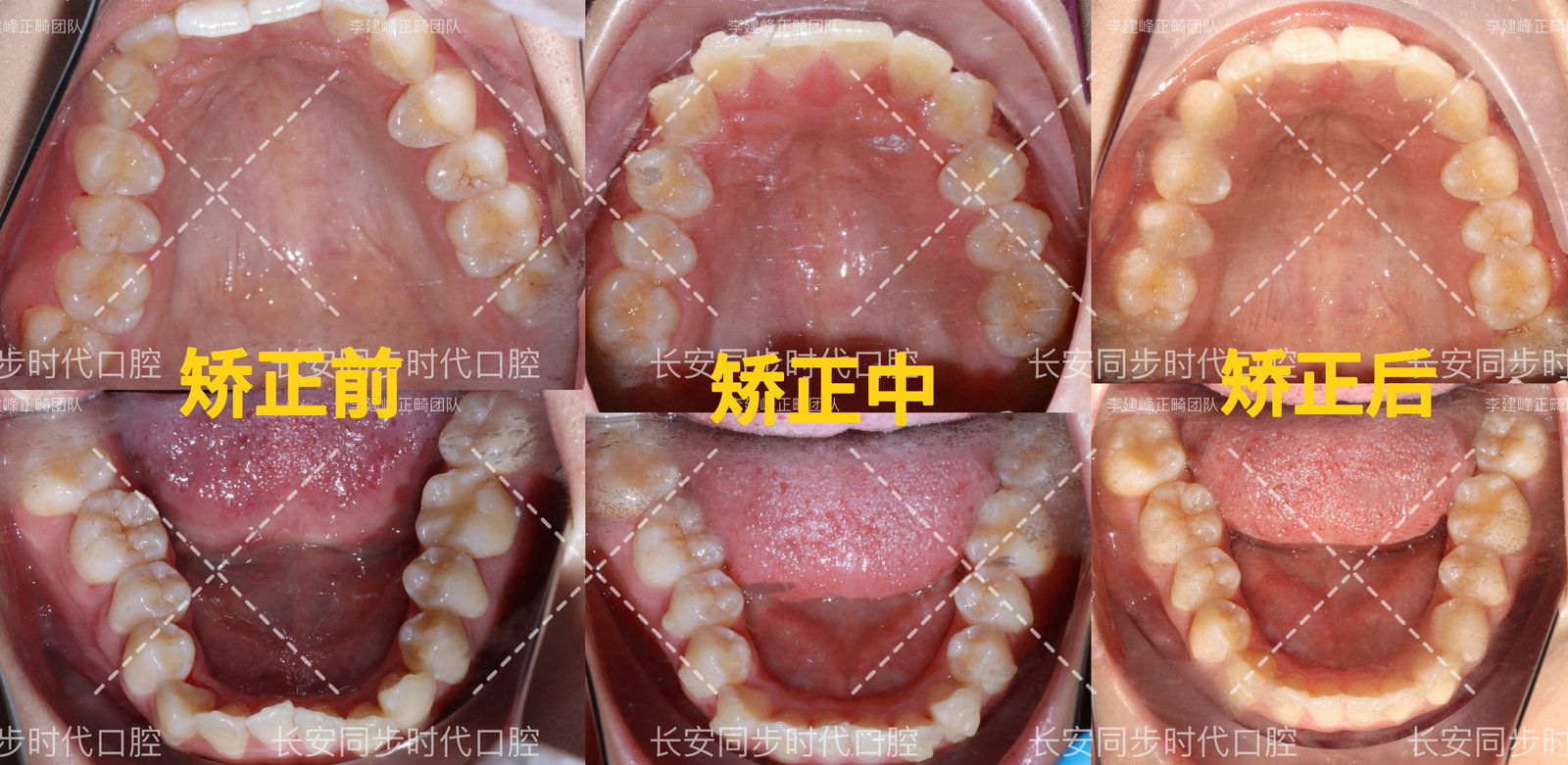 隐形矫正