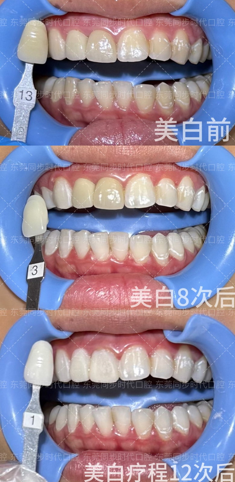 牙齿美白