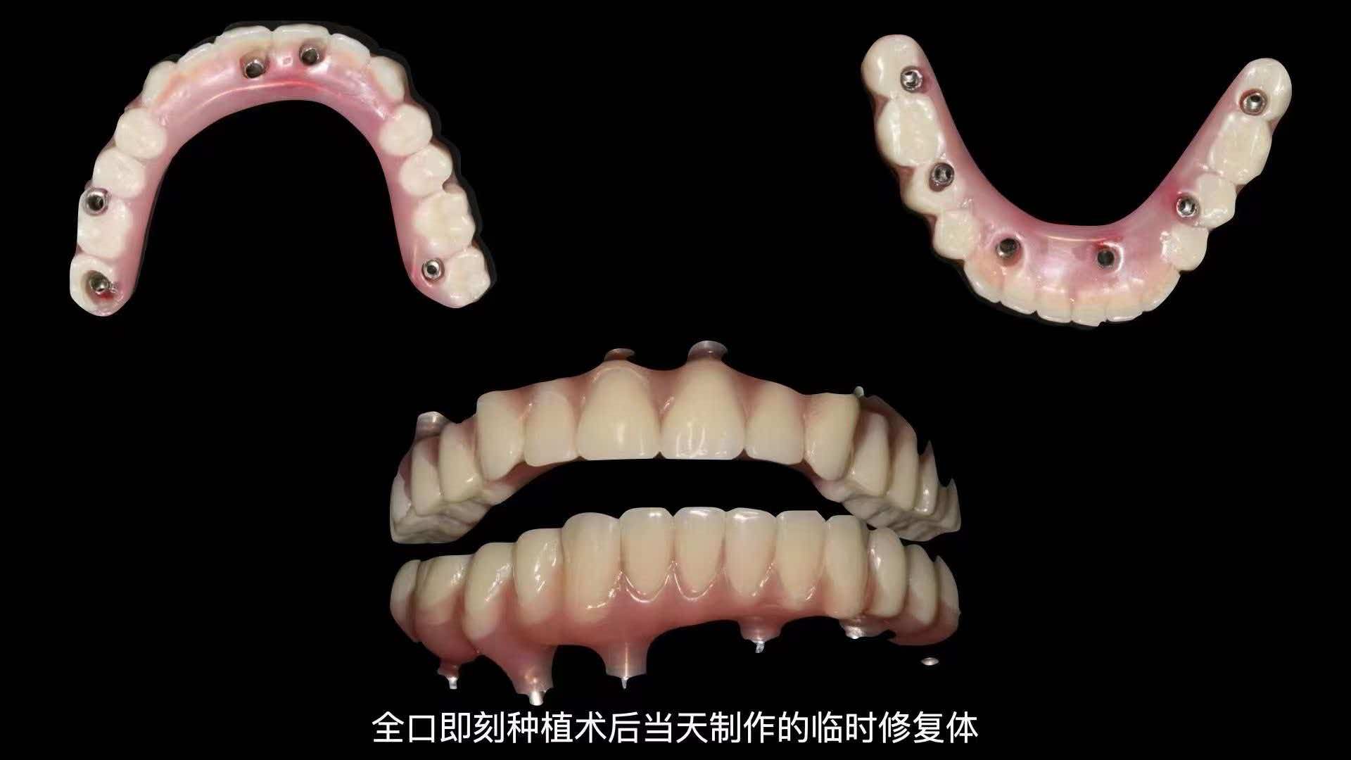 全口牙缺失，当天种植当天戴牙